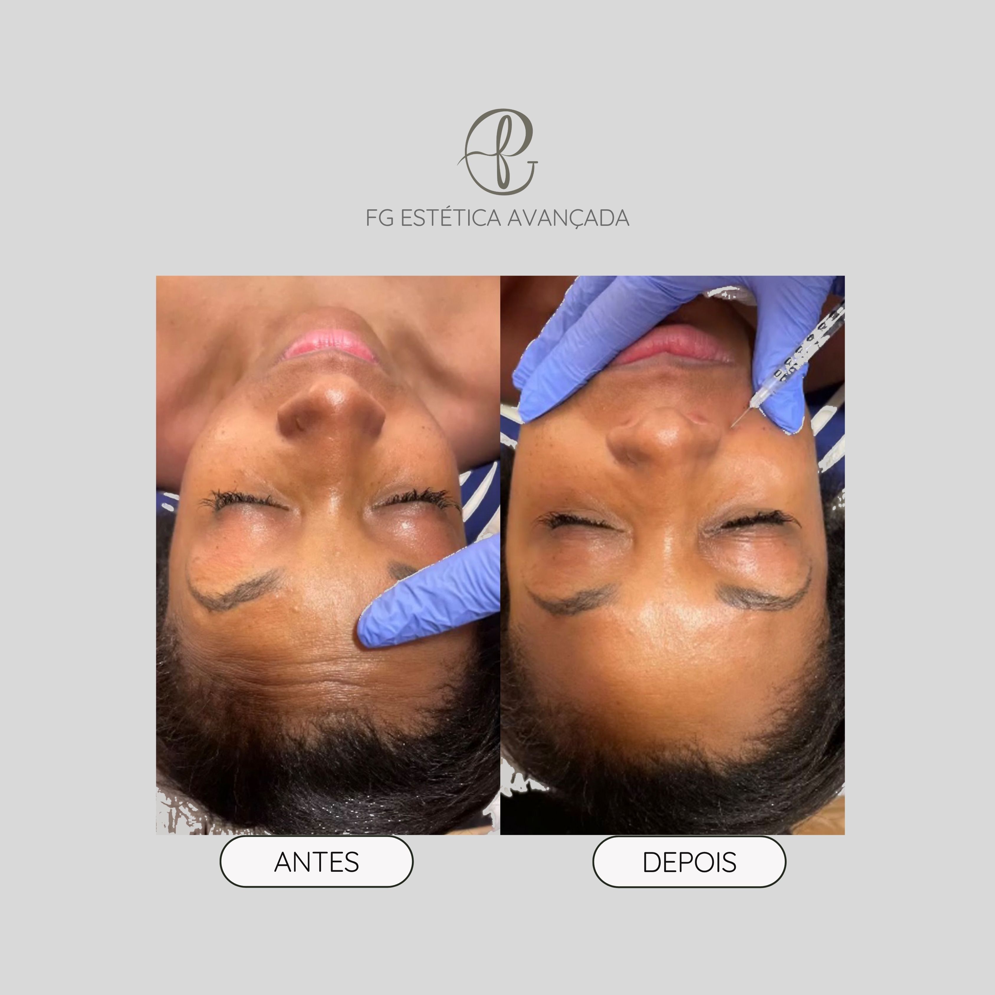 Resultado antes e depois de botox — suavização de rugas na FG Estética Avançada
