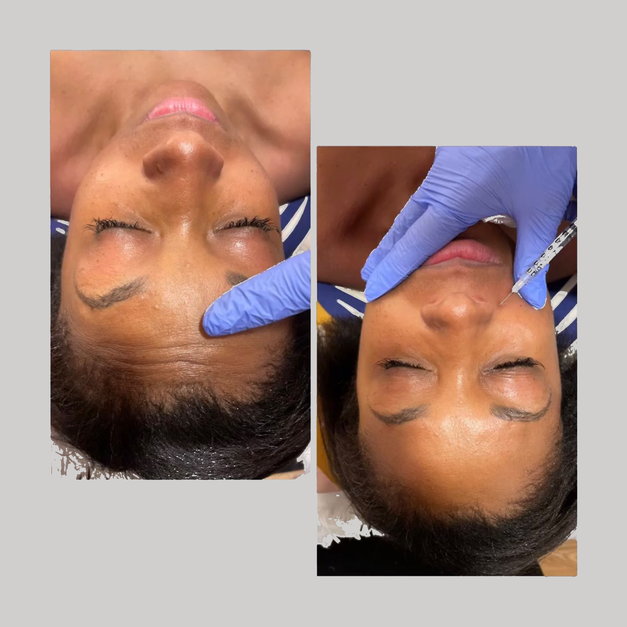 Resultado de Botox