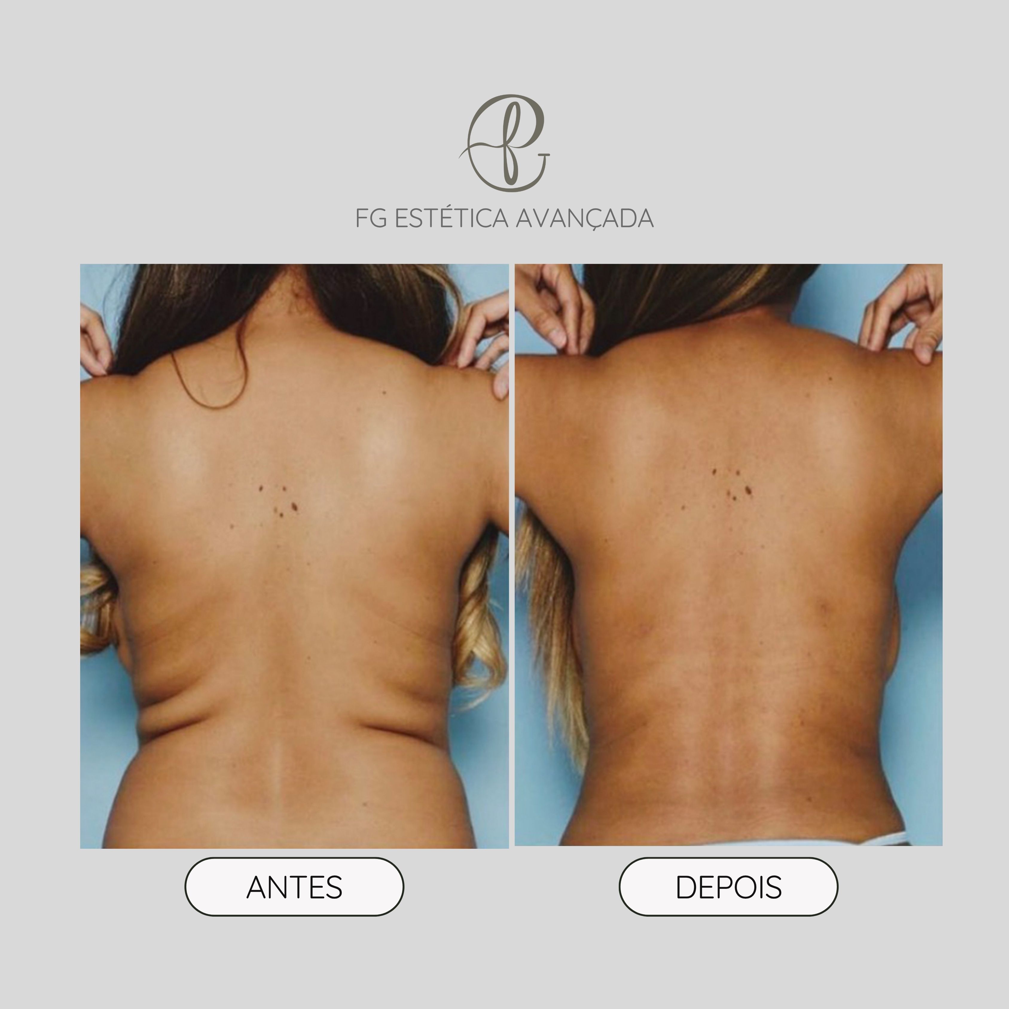 Resultado antes e depois de aplicação de enzimas — zona dorsal na FG Estética Avançada