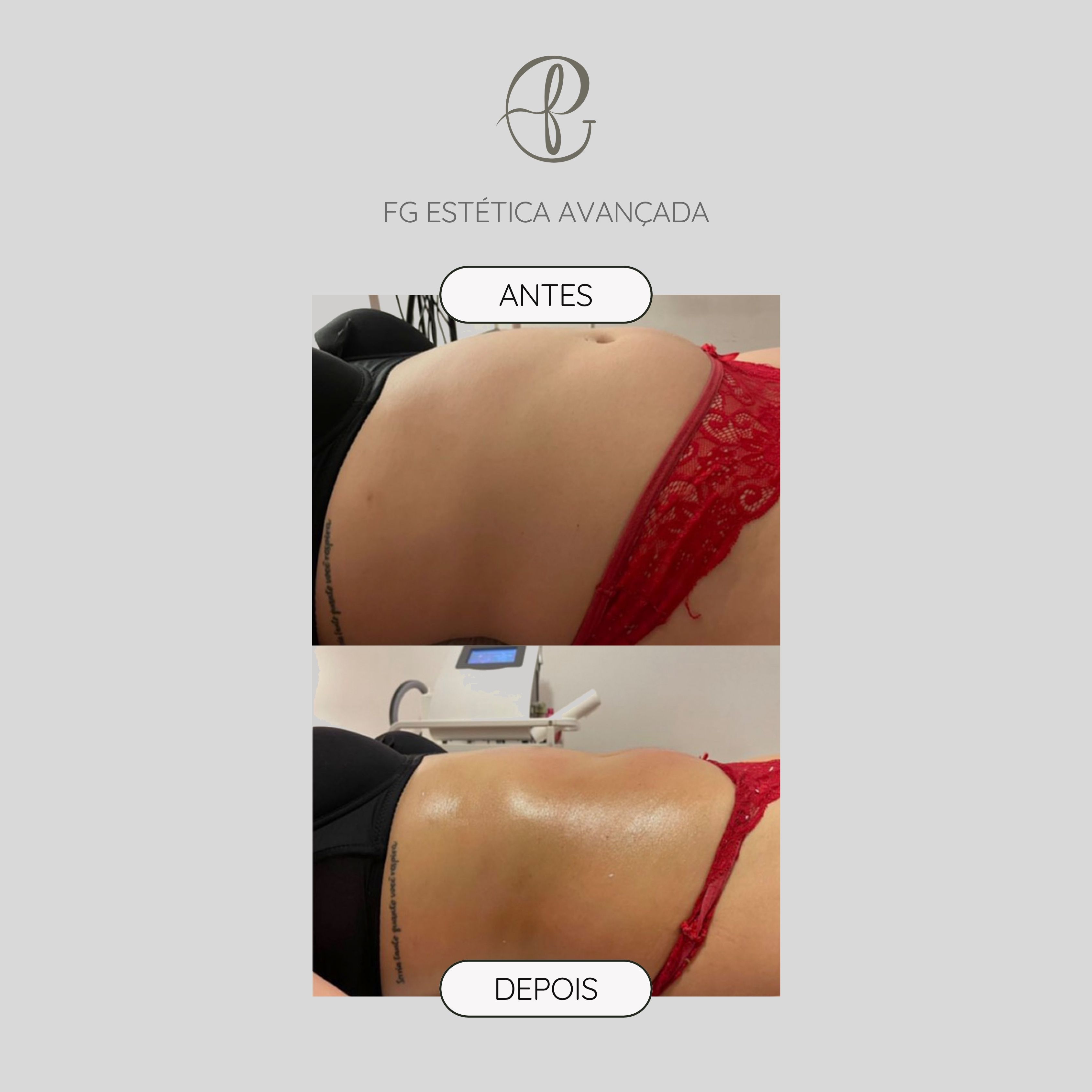 Resultado antes e depois do protocolo de contorno corporal — abdómen na FG Estética Avançada